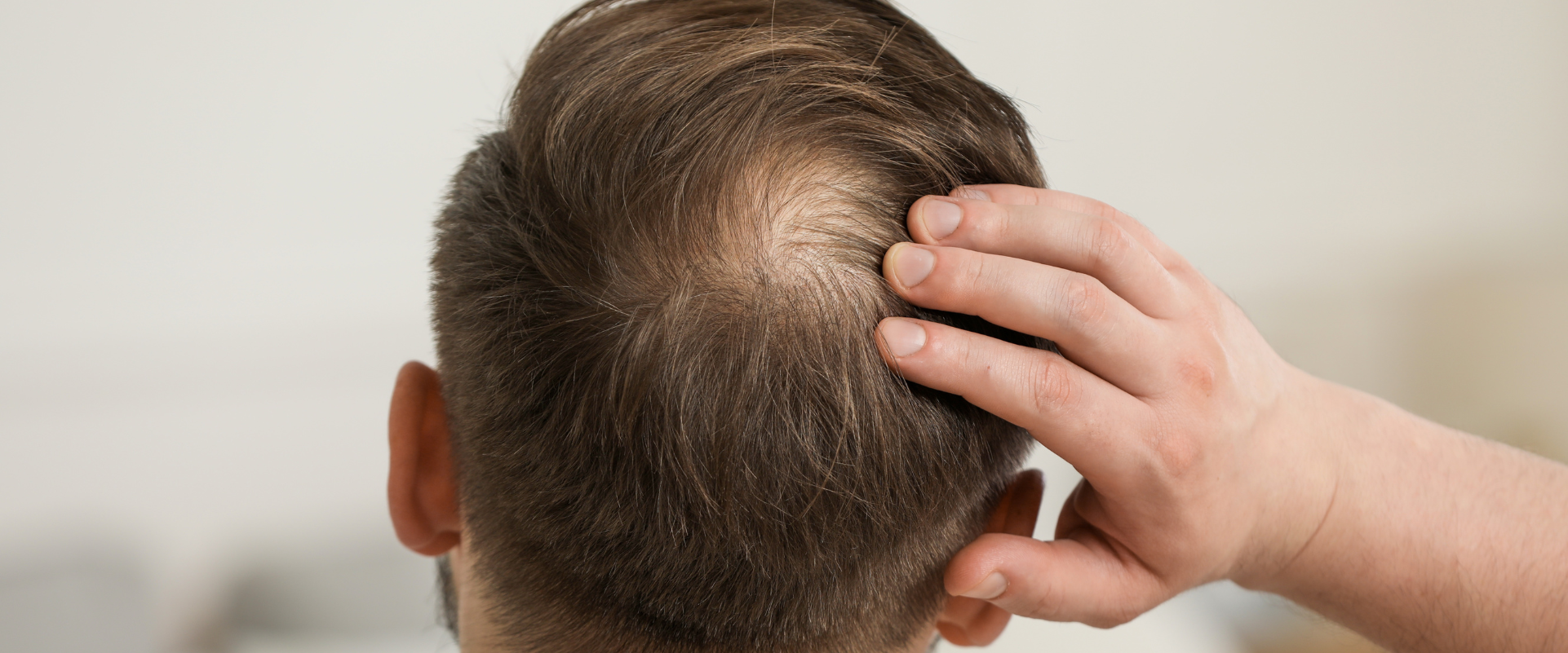 Minoxidil vs. Rogaine vs. Hair Supplements